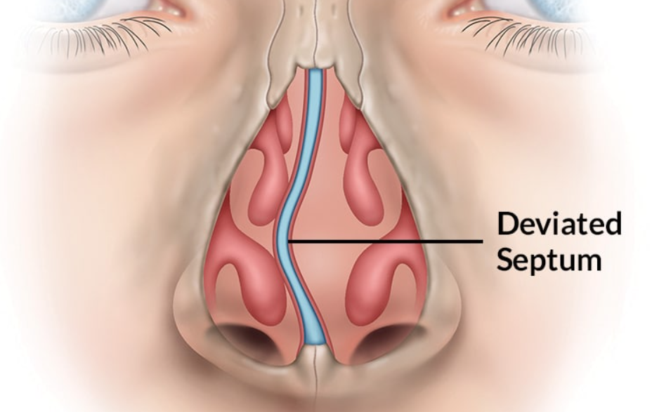 deviated nasal septum (dns)