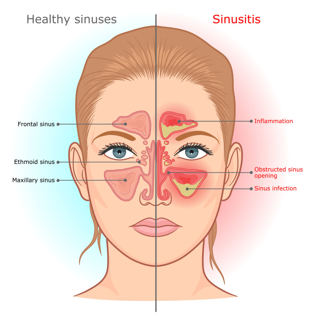 sinusitis,infection,and,normal,sinuses,medical,diagram.