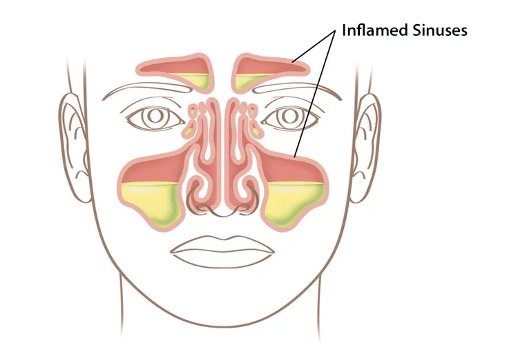 sinusitis and nasal blockage