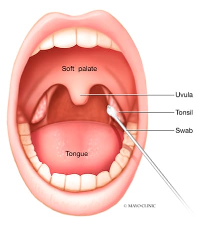 tonsillitis and throat infections